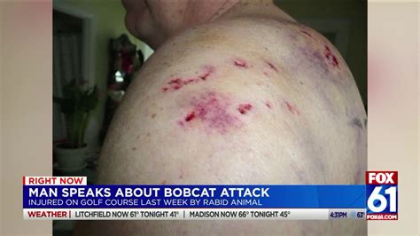 Man speaks out about rabid bobcat attack in Baltic | fox61.com