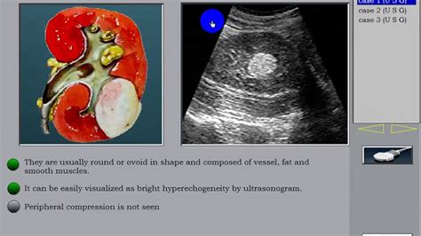 Kidney Tumor Ultrasound