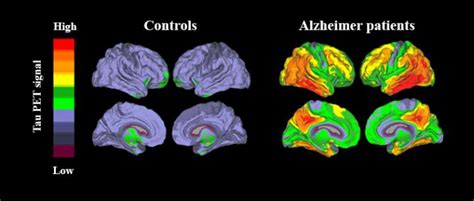 Tau PET Images [IMAGE] | EurekAlert! Science News Releases