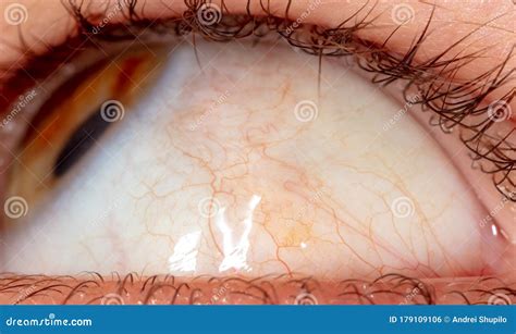 Red Veins in the Eye of a Boy, Stock Photo - Image of tear, look: 179109106