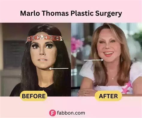 Marlo Thomas Plastic Surgery Secrets: Before And After Photos | Fabbon