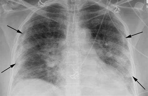 Radiologists find chest X-rays highly predictive of COVID-19