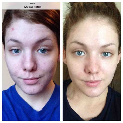 Before and after (post inflammatory hyperpigmentation) : r ...