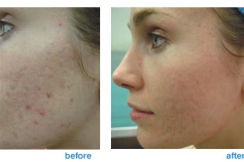 Acne Laser Scar Removal Before And After