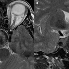 MRI T2 images of the ICA aneurysm in Patient 1 in axial view (a) and ...