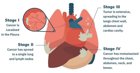 Mesothelioma Stages | Asbestos Cancer Staging & Classification