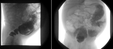 Hirschsprung’s Disease | UAMS Department of Radiology