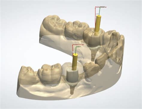 Abutment - Design Fee - CAE Dental