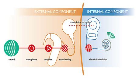 Cochlear Implants