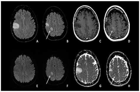 Cancers | Free Full-Text | Diffusion Weighted Imaging in Neuro-Oncology ...