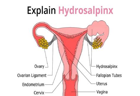 Hydrosalpinx: Symptoms, Causes & Treatment - Dr Mona Dahiya