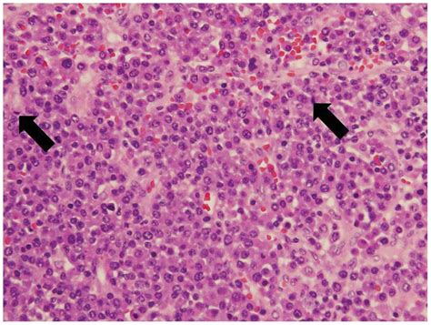 Extramedullary plasmacytoma of the nasopharynx: A case report and review of the literature