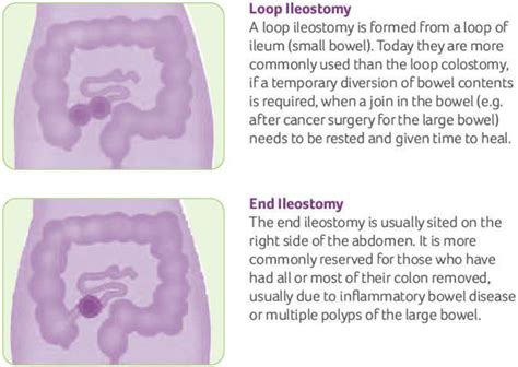 Ileostomy - Loop Ileostomy, End Ileostomy, Diet, Complications