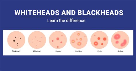 5 Methods to treat whiteheads and blackheads