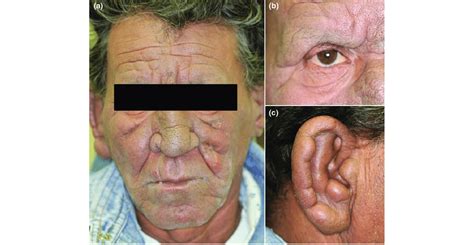 Facial features of leprosy: (a) diffuse thickening of the facial skin,... | Download Scientific ...