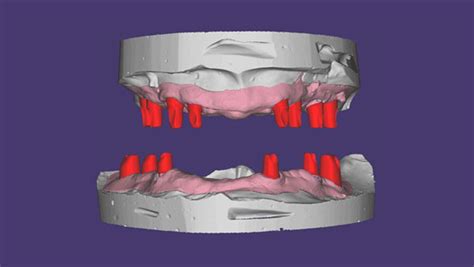 Custom Abutment Design| All on 4 Exocad Dental Design - SDS