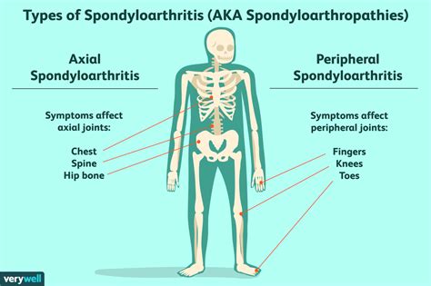 How Are Axial Spondyloarthritis and Ankylosing Spondylitis Related?