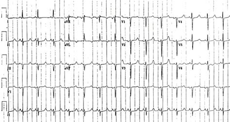 Hypocalcemia And Ecg Changes