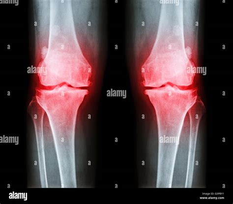 Osteoarthritis Knee Mri