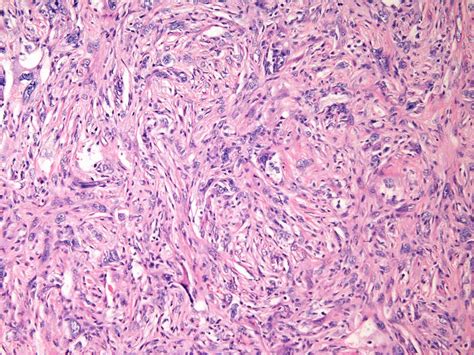 Malignant Fibrous Histiocytoma (MFH) of Bone