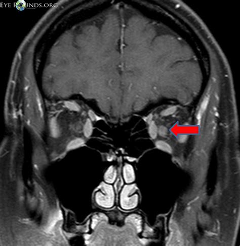 Optic neuritis: from one medical student to another medical student