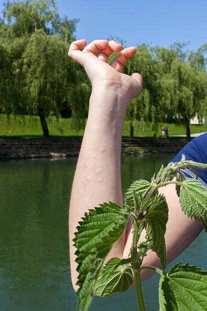 Best Stinging Nettle Reaction Stock Photos, Pictures & Royalty-Free Images - iStock