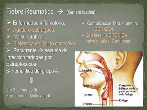 Fiebre reumática