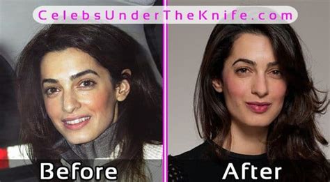 Amal Clooney Before Plastic Surgery | celebrity plastic surgery