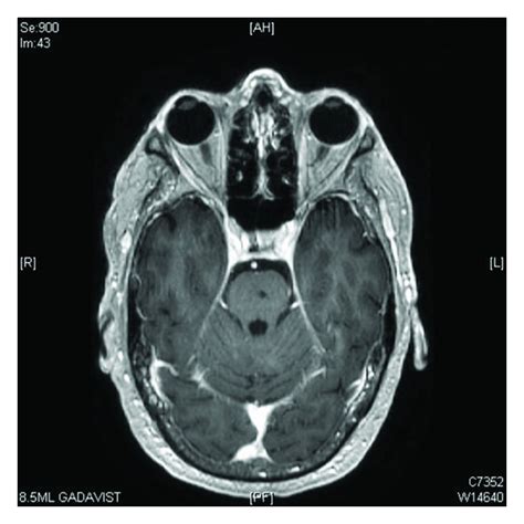 Posttreatment axial MRI image of the pons with complete ablation of the... | Download Scientific ...