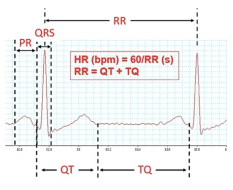 ECG practical Flashcards | Quizlet