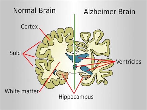 ADUHELM (aducanumab-avwa) for the Treatment of Alzheimer’s Disease