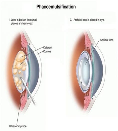 Phacoemulsification