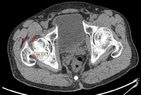 Computed tomography horizontal anterior opening angle of varus ...