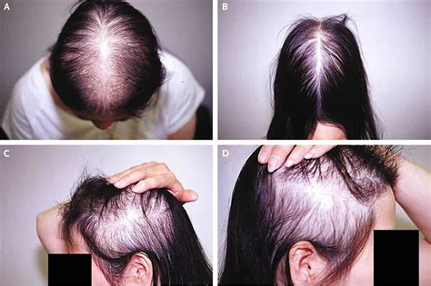 Male or female pattern baldness causes and baldness treament