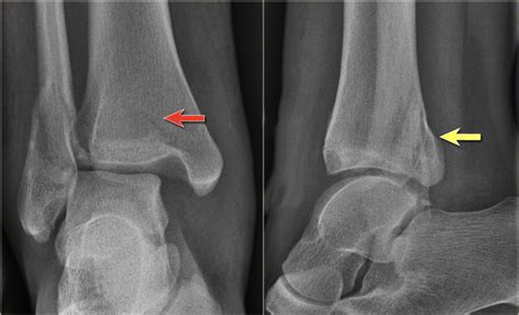 Weber B Distal Fibula Fracture