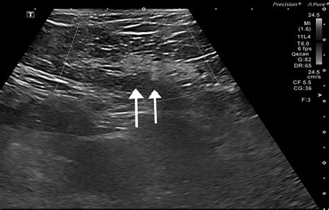 Cureus | A Rare Case of Idiopathic Gonadal Vein Thrombosis