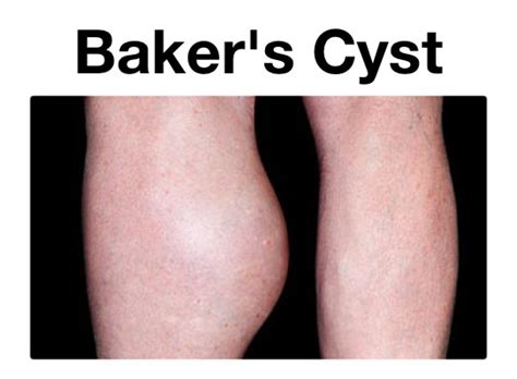 Ruptured Baker's Cyst - Emmett Technique Cairns Muscular Release Therapy, Australian made.