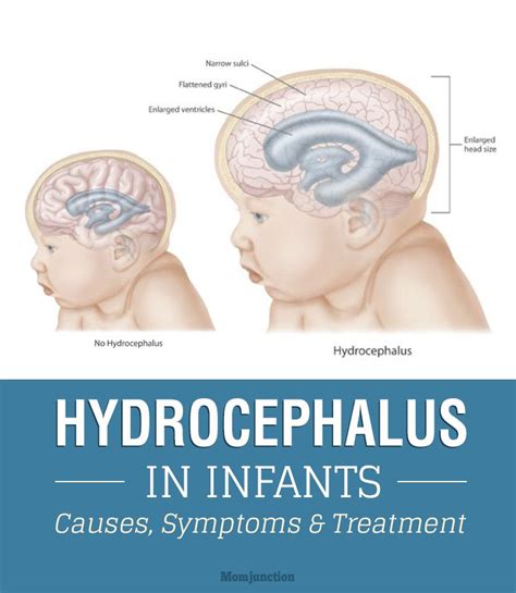 What Causes Hydrocephalus In Babies - BABBIES CIP