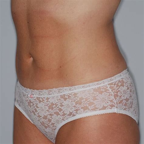 Laser Lipolysis - Smartlipo® Triplex® - Cynosure