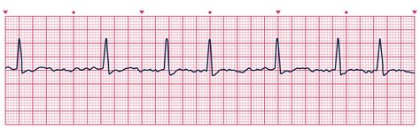 Junctional Rhythm Strip