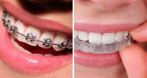 Dental Braces | Teeth Braces Cost, Procedure, Types