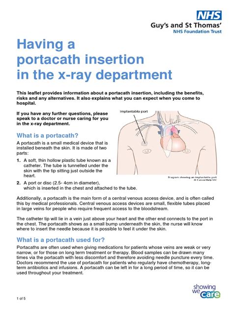 Having a portacath insertion in the x-ray department | Medicine ...