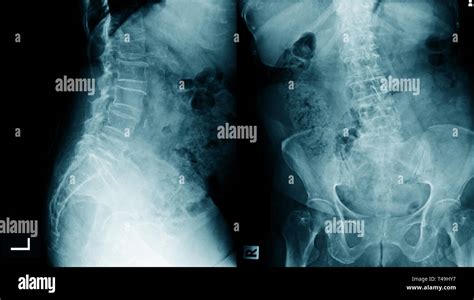 lumbar spondylosis x-ray image AP and lateral view Stock Photo - Alamy