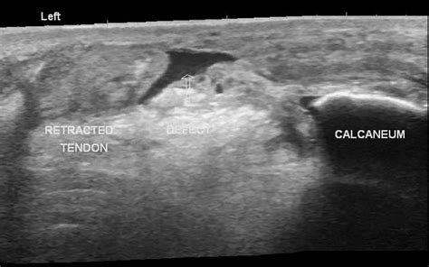 Torn Achilles Tendon Ultrasound