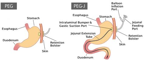 Orlando Health Digestive Health Institute – What You Need To Know About Feeding Tubes