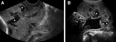 Placenta Accreta Ultrasound