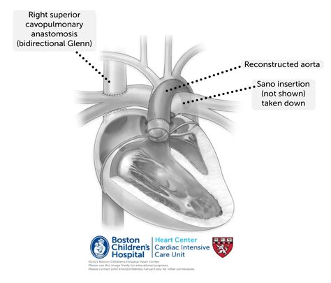 Bidirectional Glenn Shunt Procedure