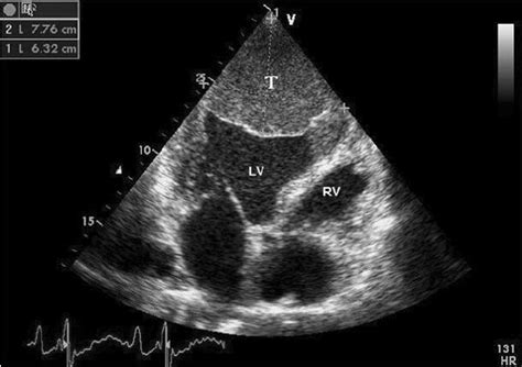 Lv Apical Aneurysm Treatment | Paul Smith