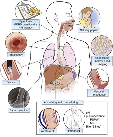 Assessing Old and New Diagnostic Tests for Gastroesophageal Reflux Disease - Gastroenterology