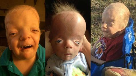 Tragic Story of Grayson Kole Smith - Boy With Rare Birth Defects, Syndrome Named After Him